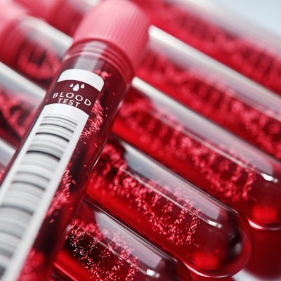 Hematology analyzers are used to count and identify blood cells at high speed and accuracy.